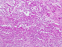 乳がんの組織像の写真