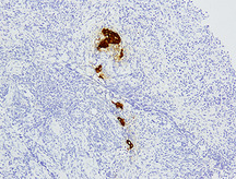 免疫組織化学がとらえたがん細胞の写真