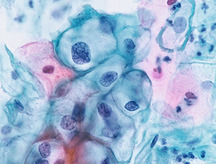 ヒトパピローマウィルス（HPV）感染細胞の写真