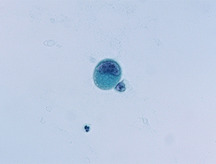 腹水中のがん細胞の写真