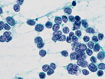 肺がん（小細胞がん）の写真
